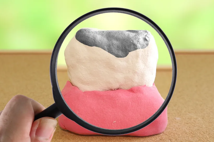 むし歯の模型（イメージ）