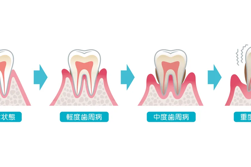 歯周病の進行段階（イメージ図）